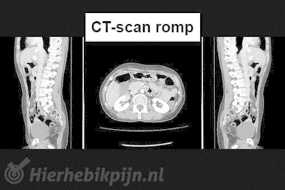 Wat is een CT scan precies?